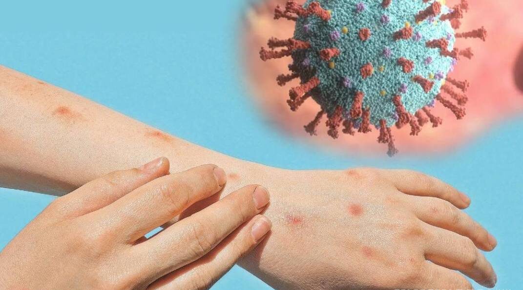 Gobierno de Nayarit desmiente confirmación de primer caso de Viruela del Mono